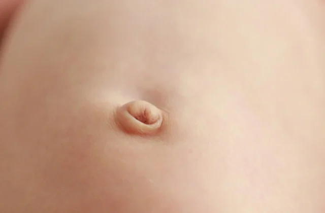 臍ヘルニアの写真