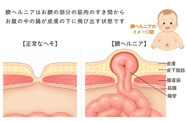 臍ヘルニアの解剖図